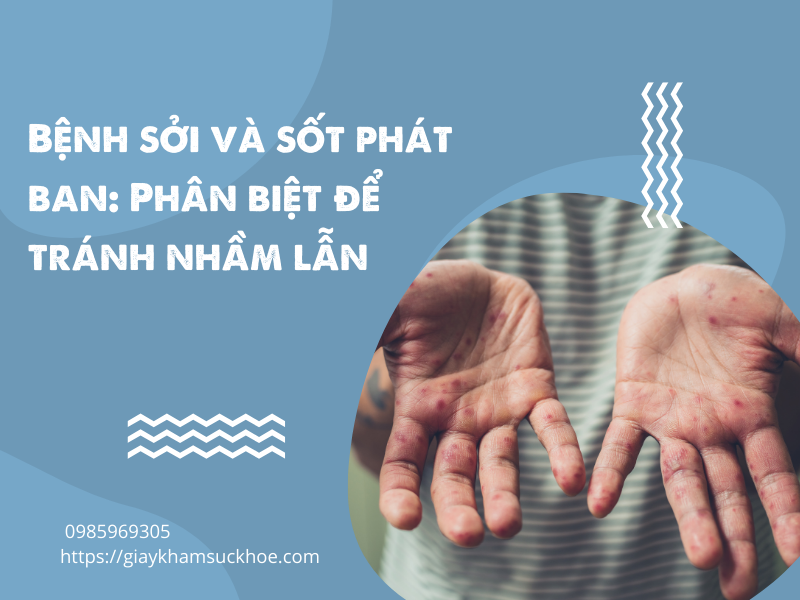 Bệnh sởi và sốt phát ban: Phân biệt để tránh nhầm lẫn