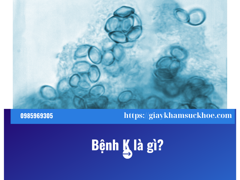 Bệnh K là gì? 5 dấu hiệu cảnh báo bạn không nên bỏ qua